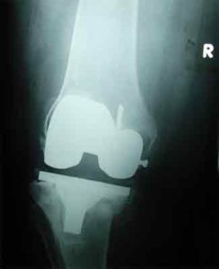 Best-dr-for-knee-replacement
