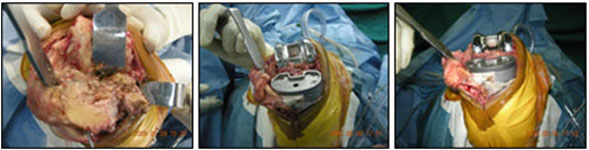 Best-shoulder-surgeon-in-Dubai